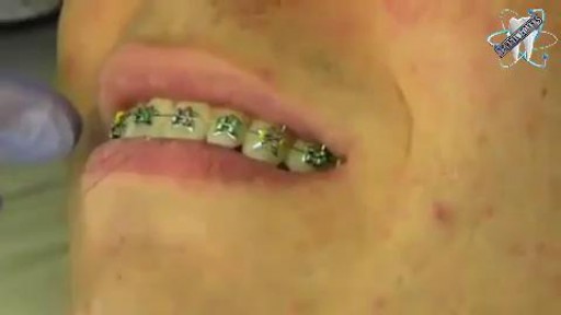⁣How Dentists Put Braces On