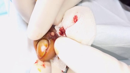 ⁣Fingernail Abscess Infection Treatment