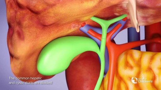 ⁣Liver Transplant Surgery Explained