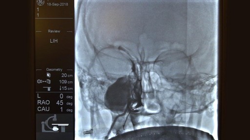 High volume sinus irrigation!