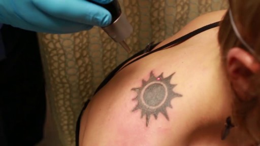 ⁣How Laser Tattoo Removal Works