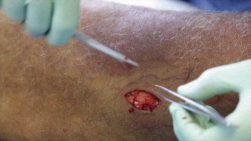⁣Basal Cell Carcinoma Excision on the Leg