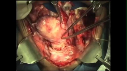 Total Abdominal Hysterectomy with Excision of a Large Ovarian Mass
