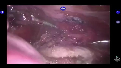 ⁣Robot-Assisted Hysterectomy Procedure