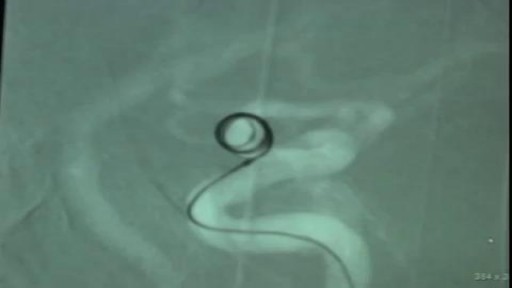 Endovascular Coiling of Unruptured Ophthalmic Artery Aneurysm