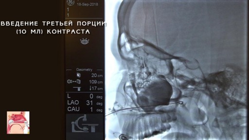 Лечение гайморита. Заполнение ОНП во время ЯМИК процедуры 4 (1)