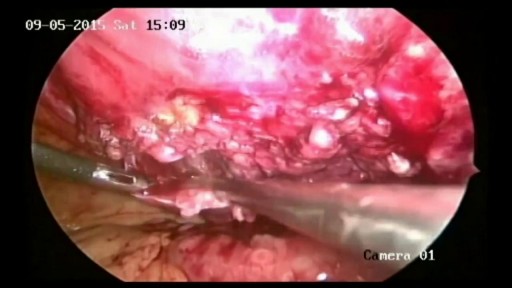 ⁣Removal of Infected Hernia Mesh