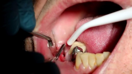⁣Drainage of Pus from a Dental Abscess