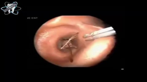 Bugs Removal from Ear Canal