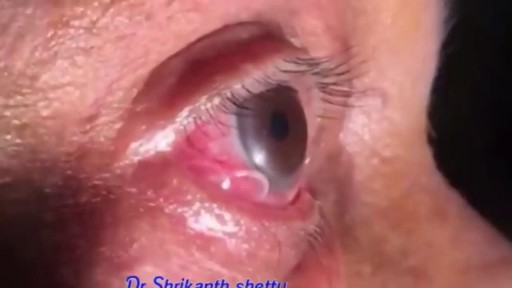 Parasitic Worm removed from Man's EYE