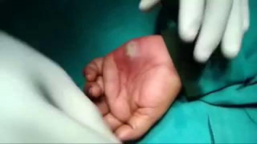 Draining a Hand Abscess