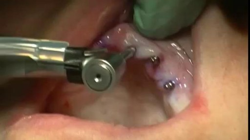 ⁣Mini Dental Implants Live Procedure