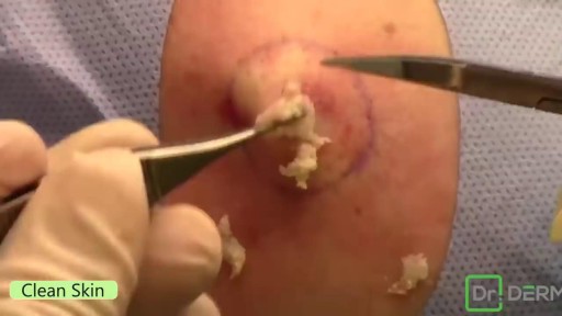 ⁣Popping Huge Cyst in the Back
