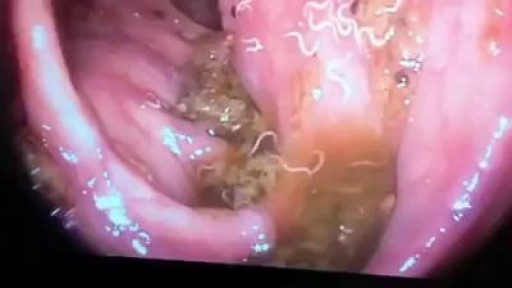 Worms Inside Human Stomach