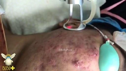 Laser Cystic Acne and Pimples Extraction