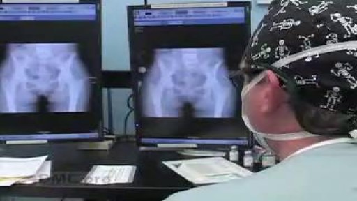 Twice the Relief: Double Hip Replacement Surgery