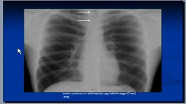 Chest X-ray, Mediastinum