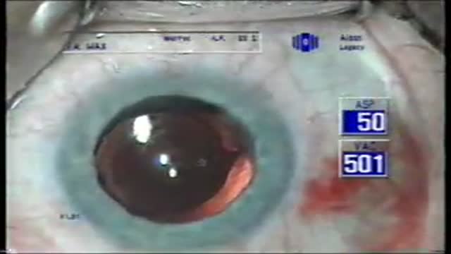⁣Implantation of a hard intraocular lens