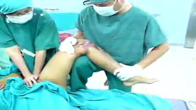 Reduction of Hip Dislocation