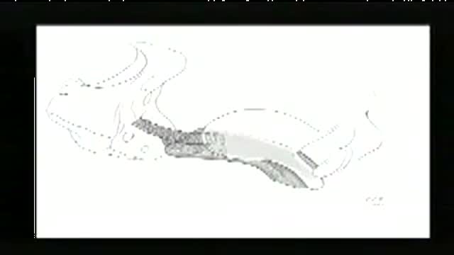 Vaginal Tape Vault Surgery: Pelvic Repair