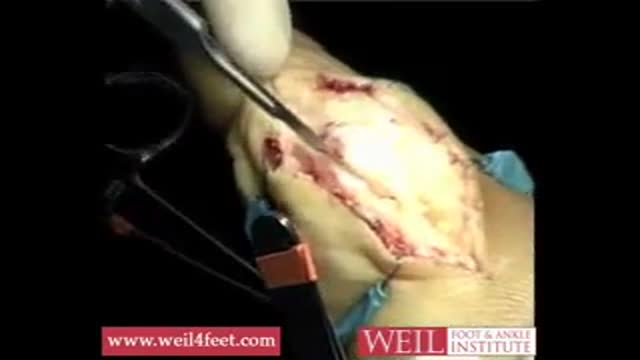 ⁣Bunion Correction with Scarf Akin Procedure