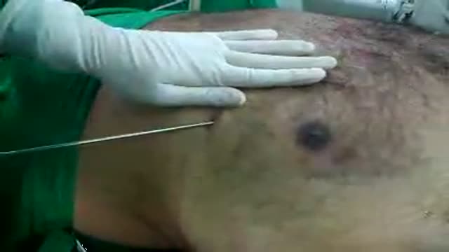 Male Breast Liposuction Reduction