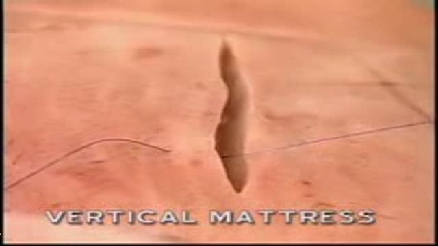 ⁣Vetical Mattress Suture