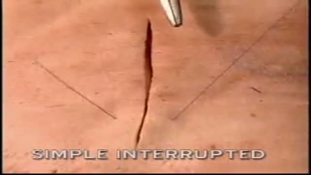 ⁣Interrupted Simple Suture