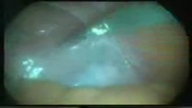 Laparoscopic varicocellectomy Surgery