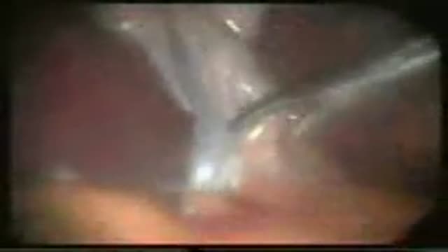 Laparoscopic varicocellectomy