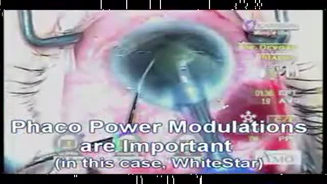 ⁣cataract surgery glaucoma tube shunt
