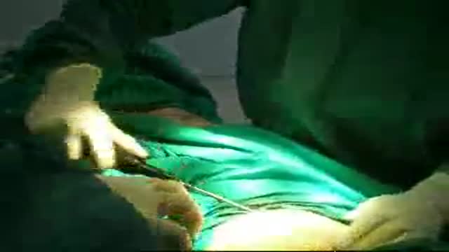 Liposuction (Lipoplasty-Fat Remodelling)