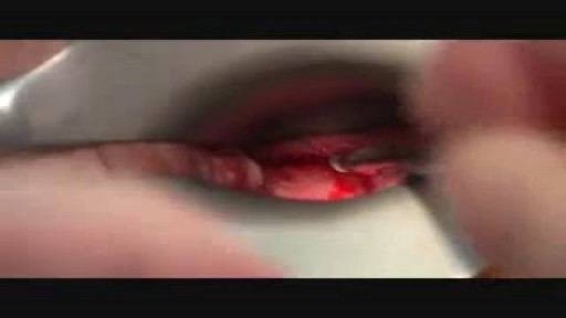 Cervicore biopsy of vaginal and cervical lesions