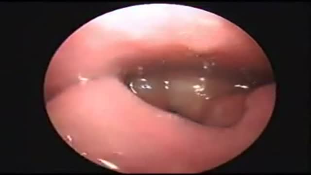 Epiglottitis