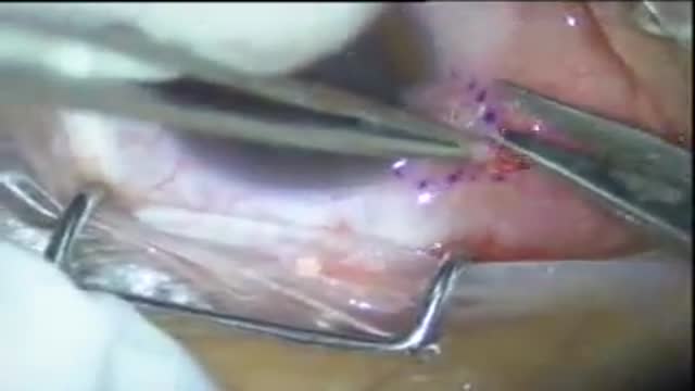 Pterygium excision and conjunctival autograft