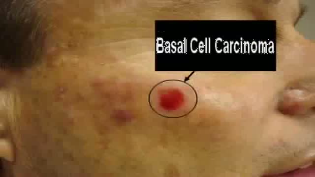 ⁣Malar Cheek Pexing Suture  / Surgery Video Vignettes