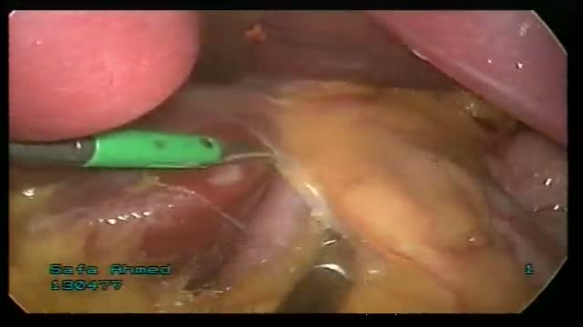 ⁣Laparoscopic Gastric Band