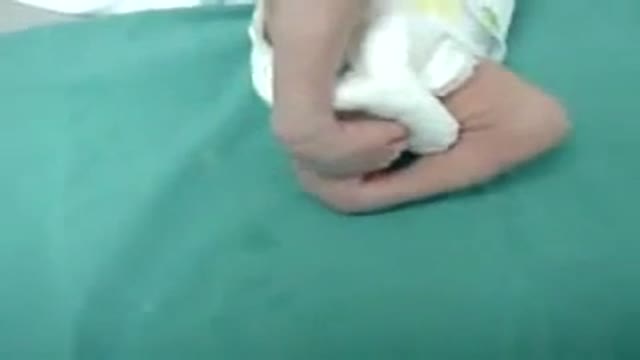 Club foot congenital talipes equinovarus (CTEV) Video