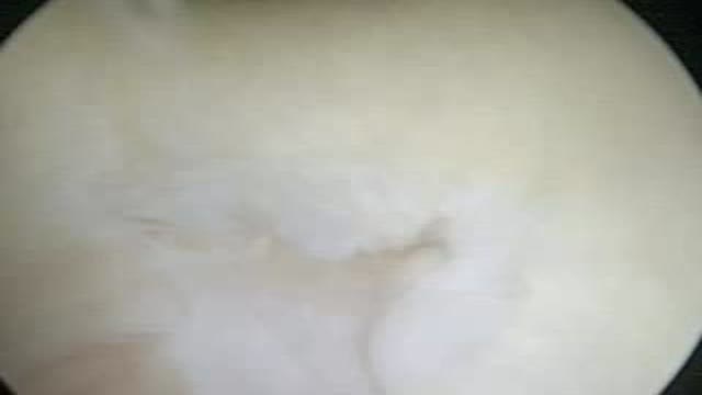 knee Arthroscopy with medial menisectomy and plica excision