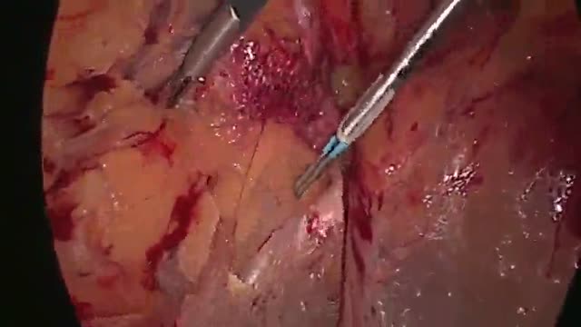 Laparoscopic inguinal hernia repair HD