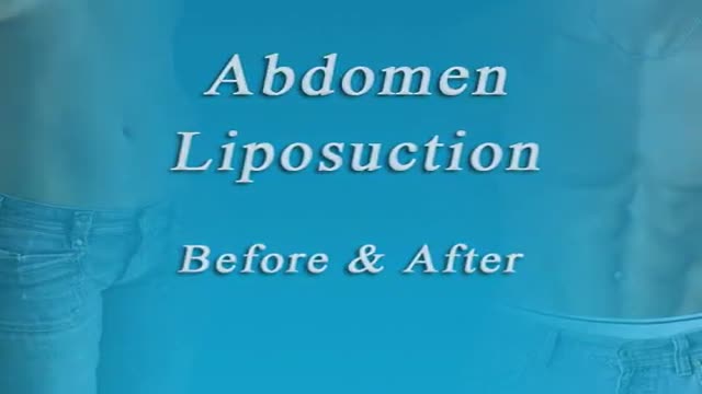 Tampa Lipo and Body Contouring