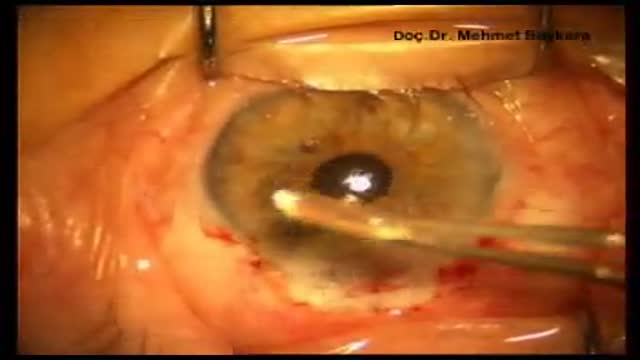 ⁣Posterior Iris Claw Lens Implantataion