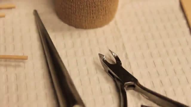 Ingrown Toenail Surgery HD