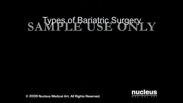 ⁣Weight Reduction Surgery Animation 3D