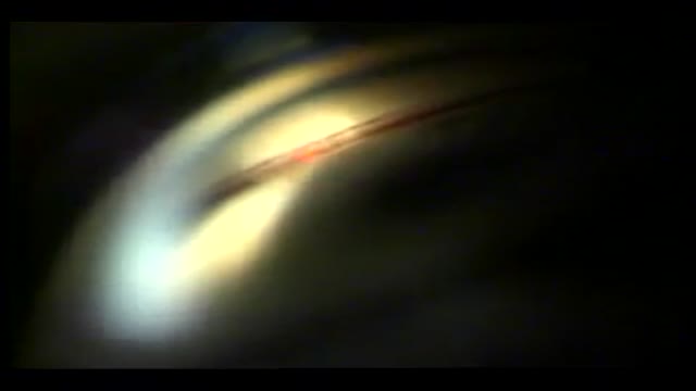 Yag Laser Trabeculoplasty for Glaucoma