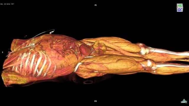 ⁣Whole Body CT scan with contrast media HD