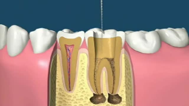 Filling Tooth Decay and Cap Animation