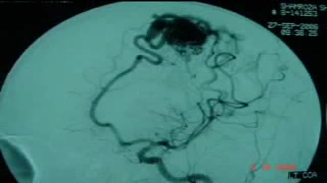 Removing ArterioVenous Malformation in Brain