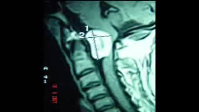 Foramen Magnum Neurofibroma Video