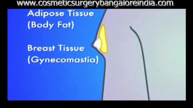 ⁣CORRECTION OF GYNECOMASTIA,Dr.M.S.VENKATESH